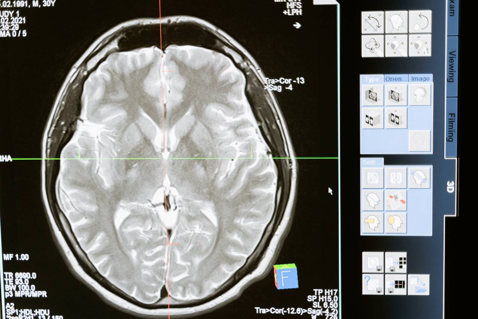 Tai Biến Mạch Máo Não – Stroke