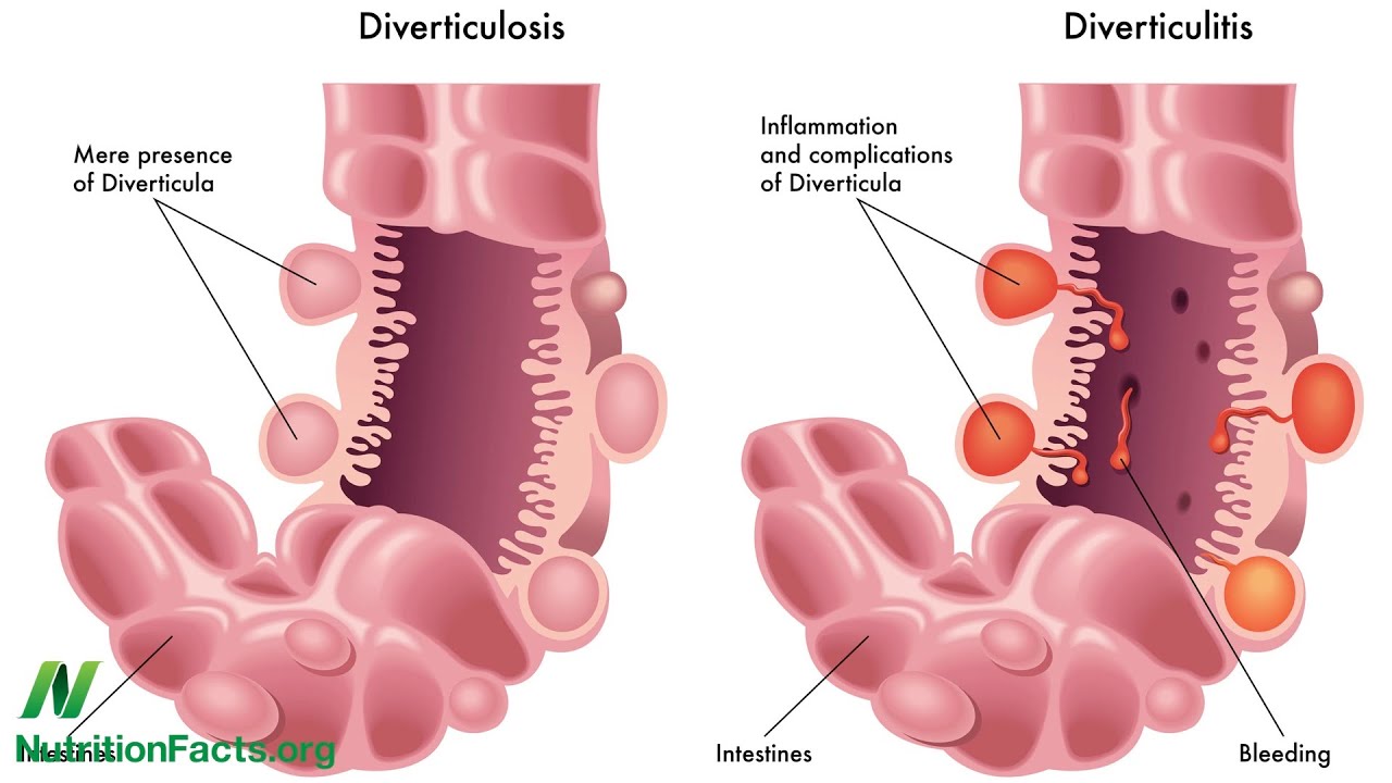BỆNH TÚI THỪA ÐẠI TRÀNG và VIÊM TÚI THỪA ÐẠI TRÀNG –  Colon diverticulosis and col